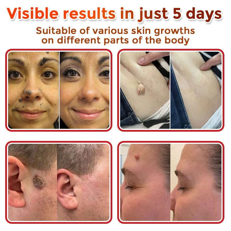 🔥GFOUK® MicroNeedle Botanic Skin Tag Removal Patch 🇺🇸 Made in the USA
