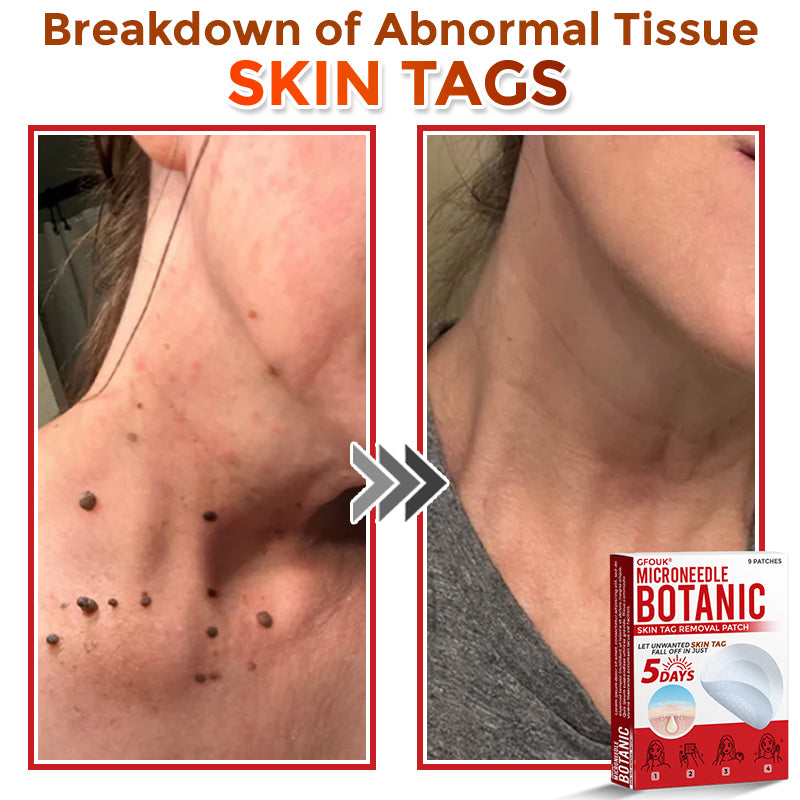 🔥GFOUK® MicroNeedle Botanic Skin Tag Removal Patch 🇺🇸 Made in the USA
