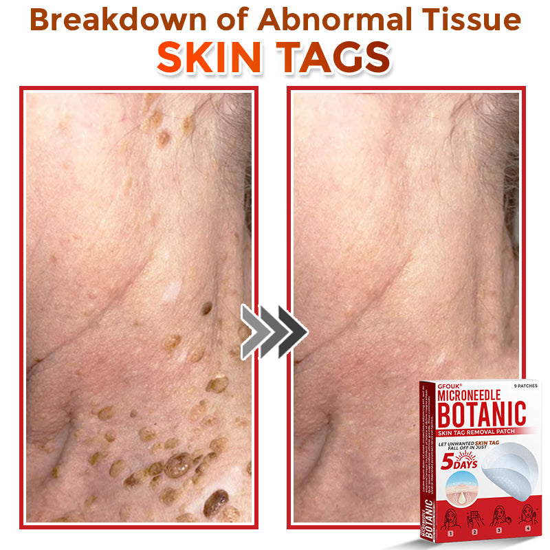 🔥GFOUK® MicroNeedle Botanic Skin Tag Removal Patch 🇺🇸 Made in the USA