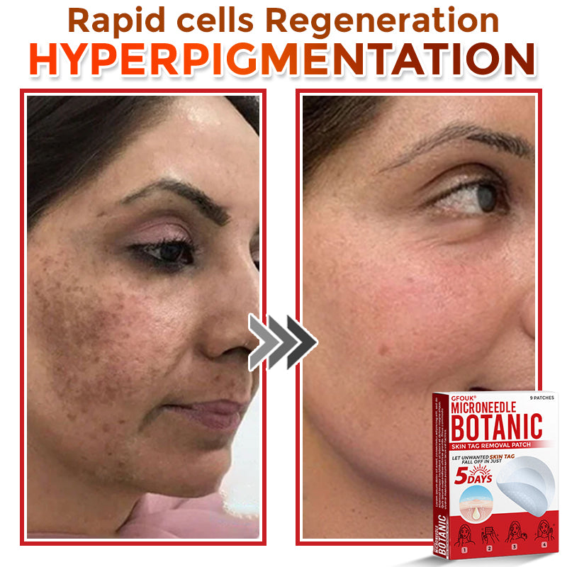 🔥GFOUK® MicroNeedle Botanic Skin Tag Removal Patch 🇺🇸 Made in the USA