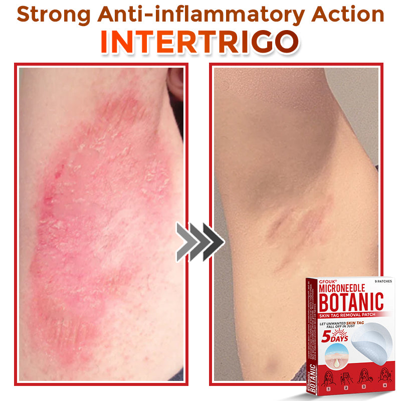 🔥GFOUK® MicroNeedle Botanic Skin Tag Removal Patch 🇺🇸 Made in the USA