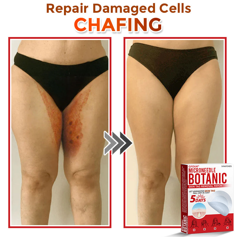 🔥GFOUK® MicroNeedle Botanic Skin Tag Removal Patch 🇺🇸 Made in the USA