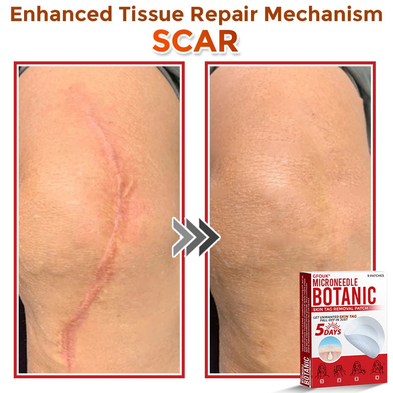 🔥GFOUK® MicroNeedle Botanic Skin Tag Removal Patch 🇺🇸 Made in the USA
