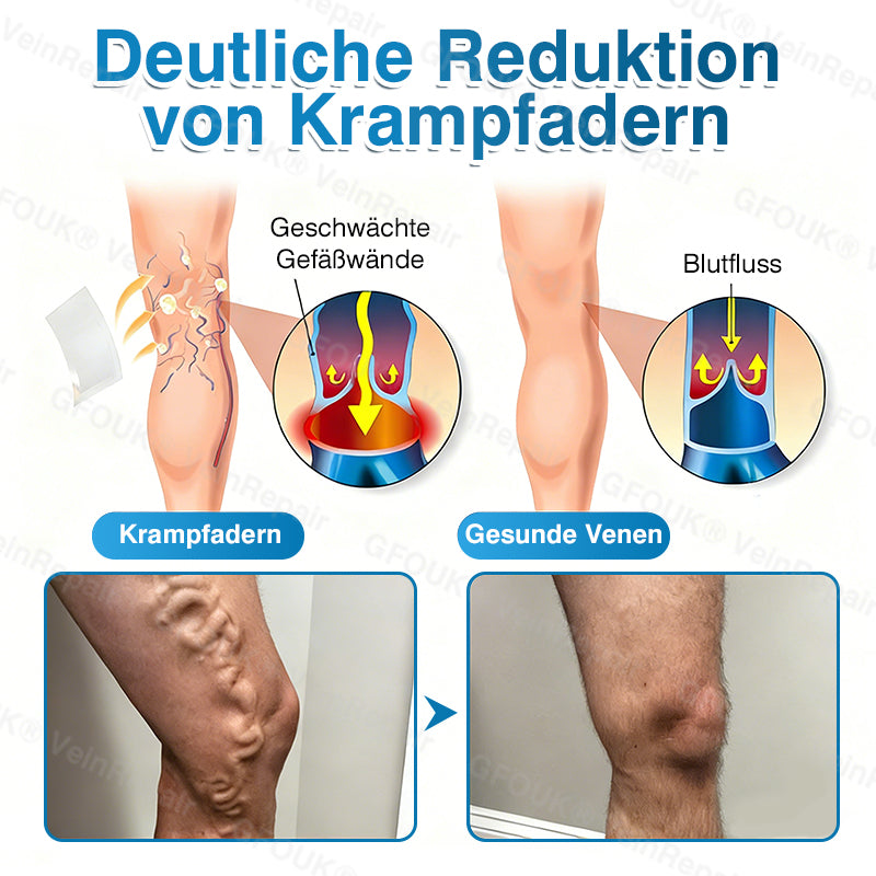 🇩🇪✅️👨‍⚕️✅️GFOUK® VeinRepair Mikronadel-Pflasterrolle⚡Sofortige Linderung, langfristige Ergebnisse