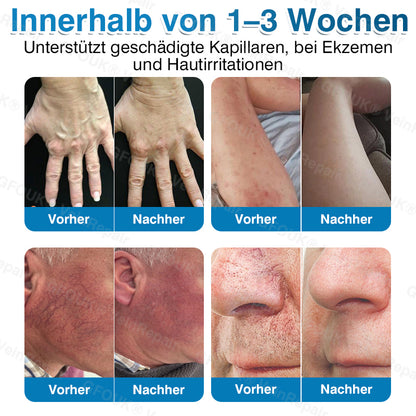 🇩🇪✅️👨‍⚕️✅️GFOUK® VeinRepair Mikronadel-Pflasterrolle⚡Sofortige Linderung, langfristige Ergebnisse