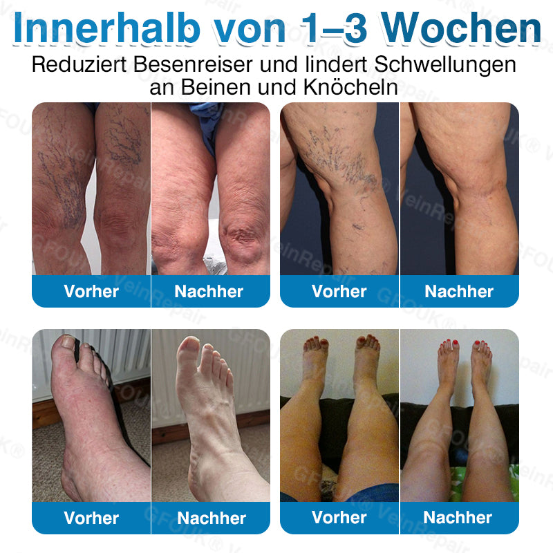 🇩🇪✅️👨‍⚕️✅️GFOUK® VeinRepair Mikronadel-Pflasterrolle⚡Sofortige Linderung, langfristige Ergebnisse