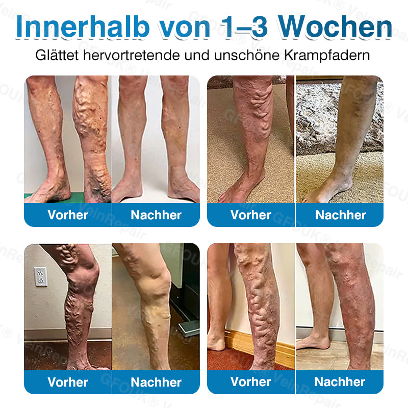 🇩🇪✅️👨‍⚕️✅️GFOUK® VeinRepair Mikronadel-Pflasterrolle⚡Sofortige Linderung, langfristige Ergebnisse