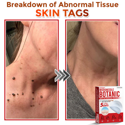 🔥GFOUK® MicroNeedle Botanic Skin Tag Removal Patch 🇺🇸 Made in the USA