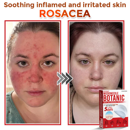 🔥GFOUK® MicroNeedle Botanic Skin Tag Removal Patch 🇺🇸 Made in the USA