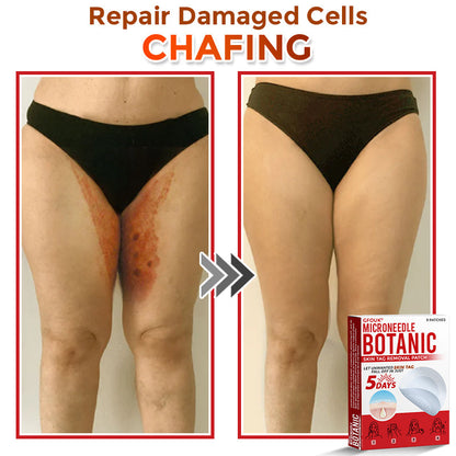 🔥GFOUK® MicroNeedle Botanic Skin Tag Removal Patch 🇺🇸 Made in the USA