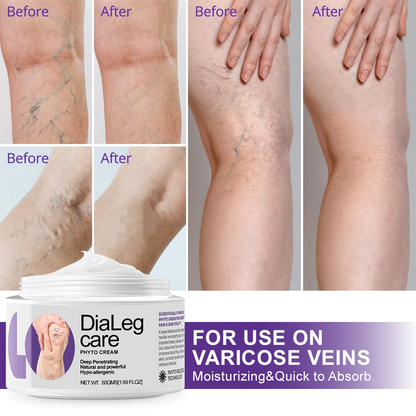 [🦵🏼Visible Results in Just 3 Days] Approved by Health Canada🍁Ourlyard® DiaLeg Care Phyto Cream – helps treat varicose veins, swelling, cramps, and leg pain